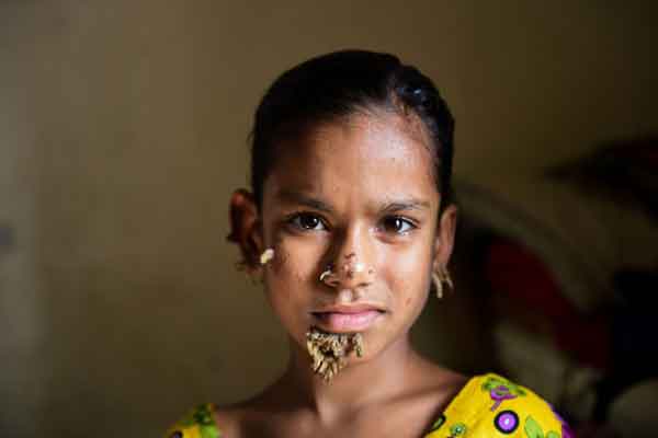 Premier cas mondial de «femme-arbre» au Bangladesh ?